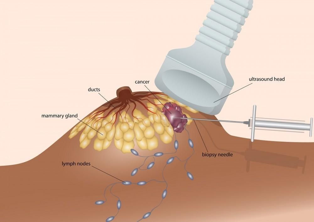 Illustration of ultrasound-guided breast biopsy showing biopsy needle, ultrasound head, and breast tissue with cancer and lymph nodes.