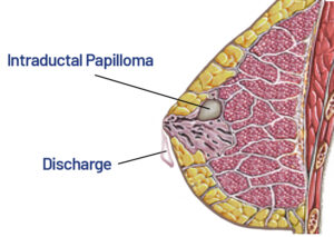 Illustration of intraductal papilloma causing nipple discharge – explained by Dr. Norran Hussein, Breast Surgeon in Dubai.
