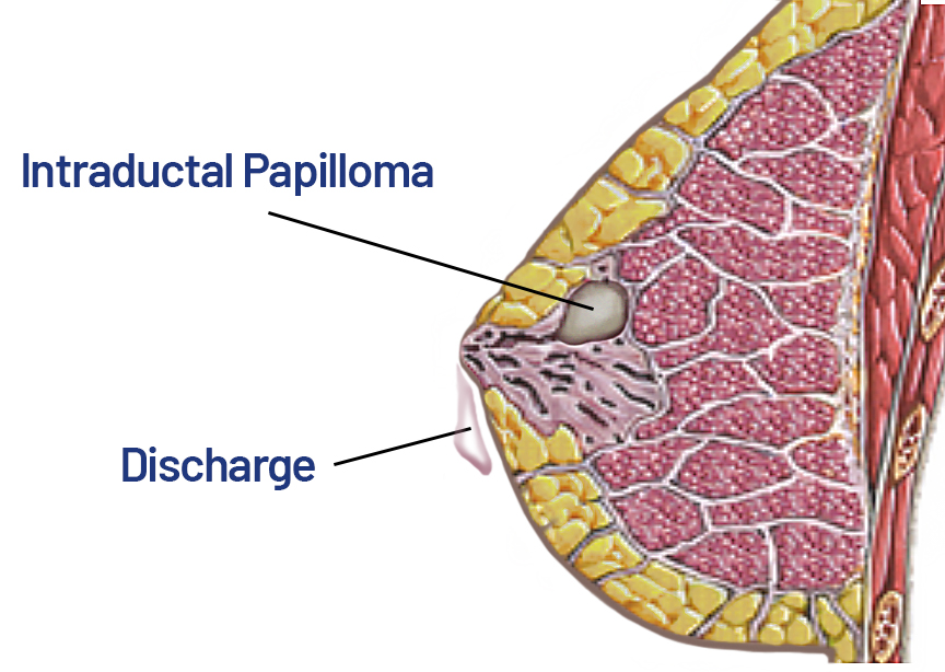 Illustration of intraductal papilloma causing nipple discharge – explained by Dr. Norran Hussein, Breast Surgeon in Dubai.