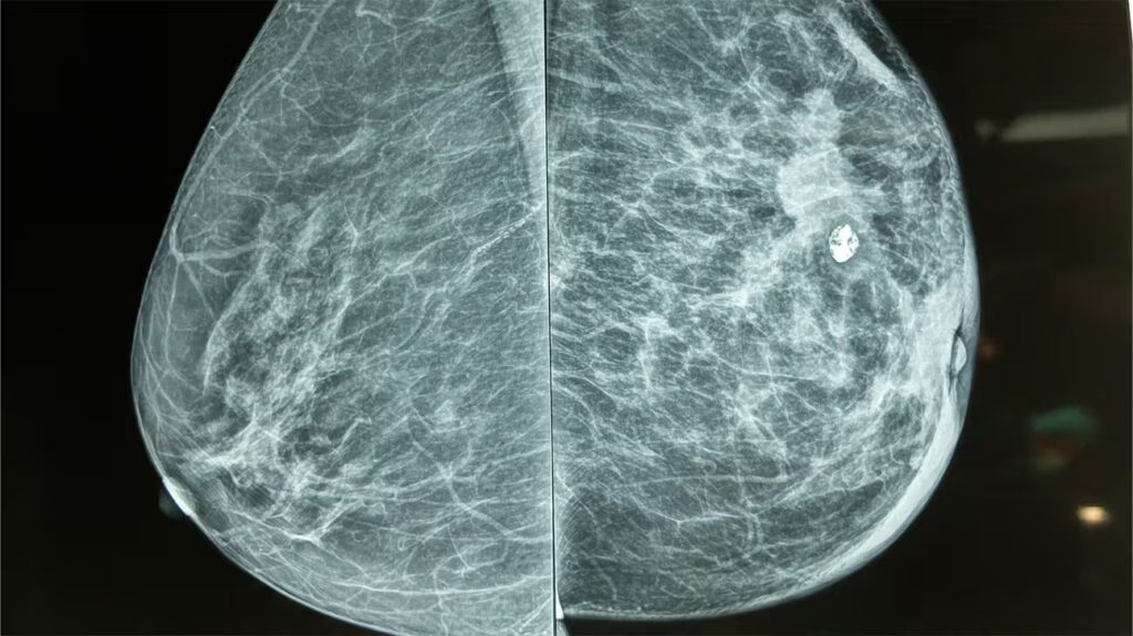 Mammogram in Dubai showing breast tissue X-ray used for early breast cancer detection – explained by Dr. Norran Hussein, Breast Surgeon.