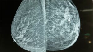 Mammogram in Dubai showing breast tissue X-ray used for early breast cancer detection – explained by Dr. Norran Hussein, Breast Surgeon.